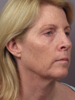 Facelift Before and after photo