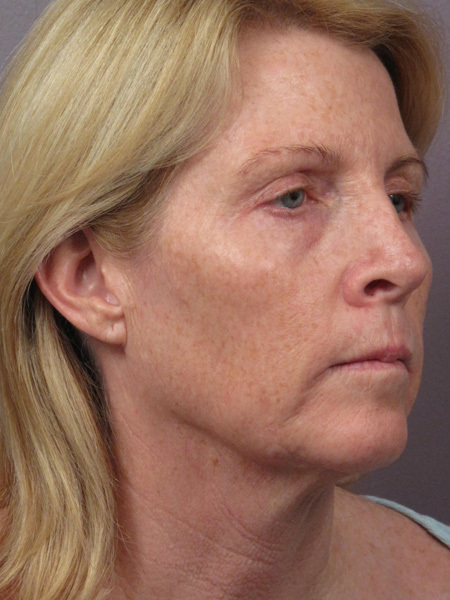 Facelift before and after photo