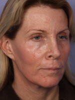 Facelift Before and after photo