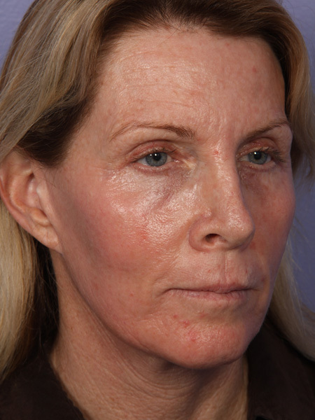 Facelift before and after photo