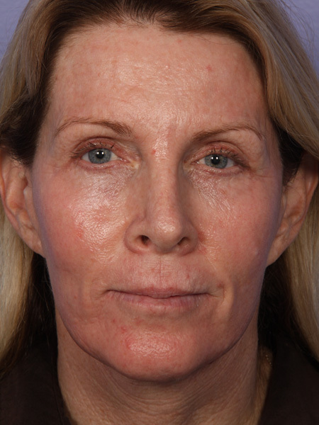 Facelift before and after photo