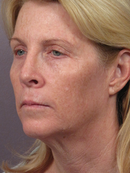 Facelift before and after photo