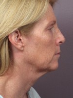 Facelift Before and after photo