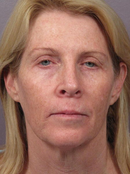 Facelift before and after photo