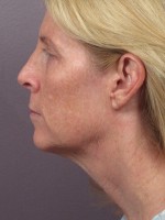 Facelift Before and after photo