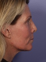 Facelift Before and after photo