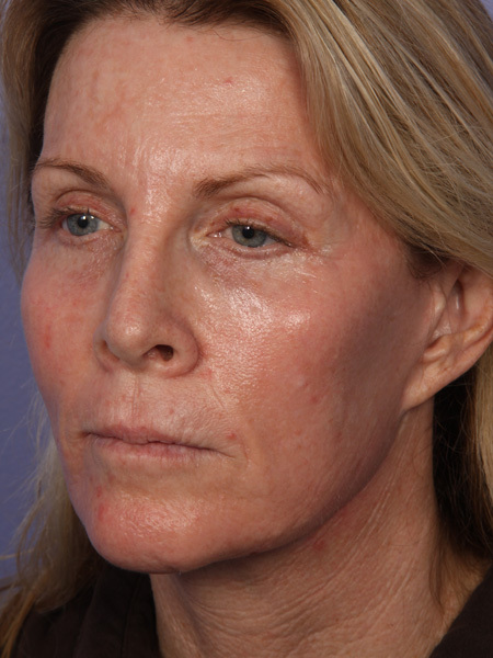 Facelift before and after photo