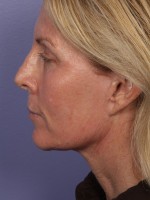 Facelift Before and after photo