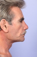 Facelift Before and after photo