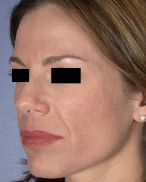 Facelift before and after photo