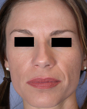 Facelift before and after photo