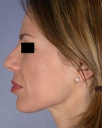 Facelift Before and after photo