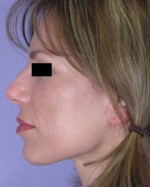 Facelift Before and after photo