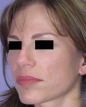 Facelift before and after photo