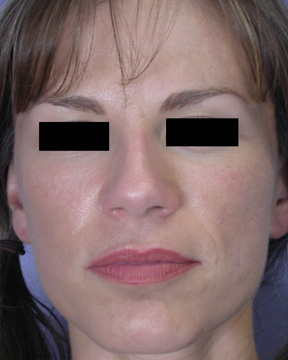 Facelift before and after photo