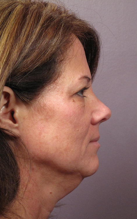 Facelift before and after photo