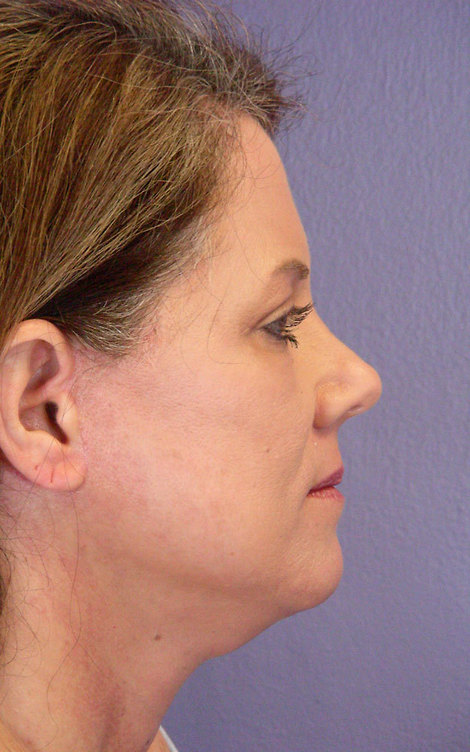 Facelift before and after photo