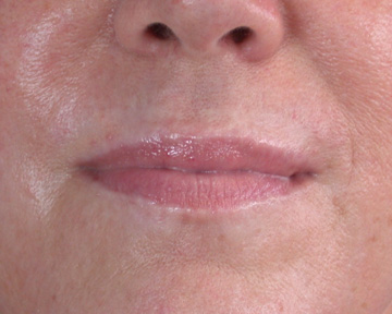 Facelift before and after photo