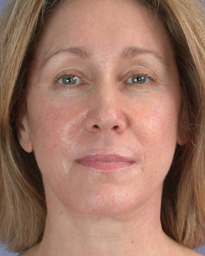 Facelift before and after photo