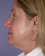 Facelift Before and after photo