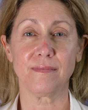 Facelift before and after photo