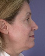 Facelift Before and after photo