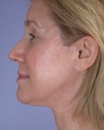 Facelift Before and after photo