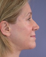 Facelift Before and after photo