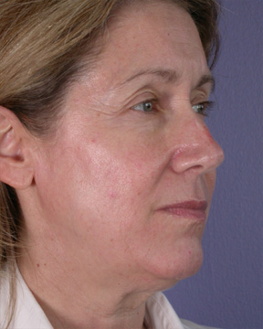 Facelift before and after photo