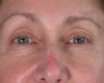 Facelift Before and after photo