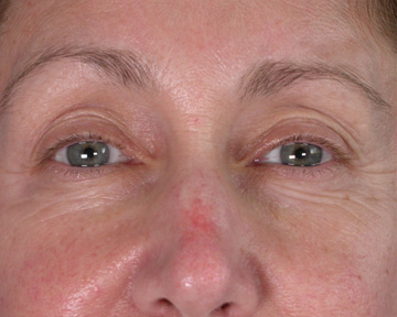 Facelift before and after photo