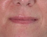 Facelift Before and after photo