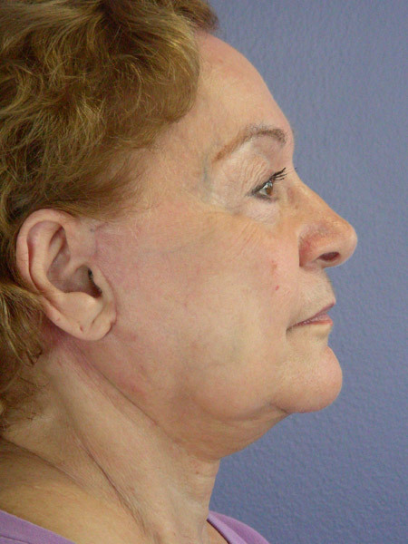 Facelift before and after photo