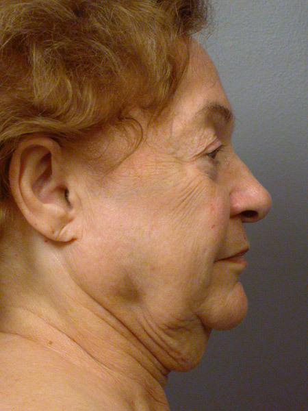 Facelift before and after photo