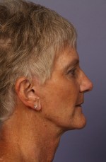 Facelift Before and after photo