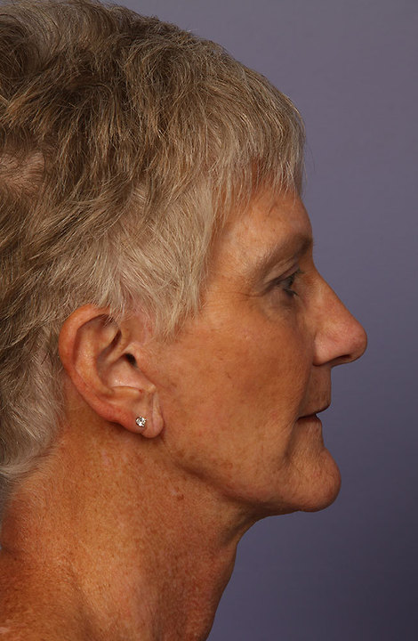 Facelift before and after photo