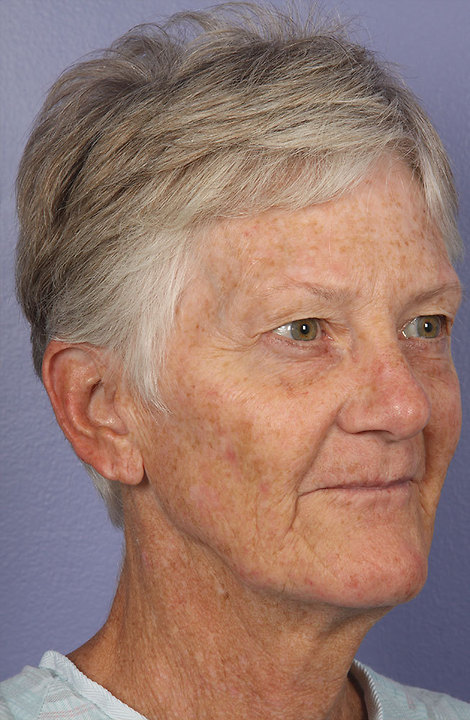 Facelift before and after photo