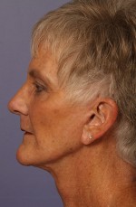 Facelift Before and after photo