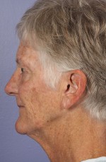 Facelift Before and after photo