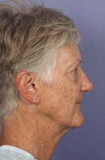 Facelift Before and after photo