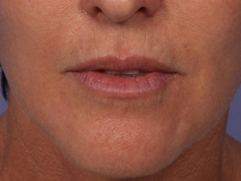 Injectable Fillers before and after photo