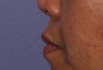 Injectable Fillers Before and after photo