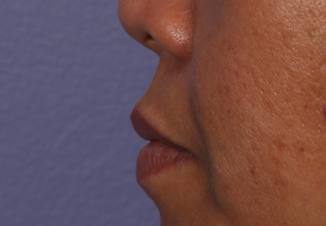 Injectable Fillers before and after photo