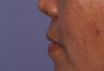 Injectable Fillers Before and after photo