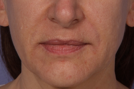 Injectable Fillers before and after photo