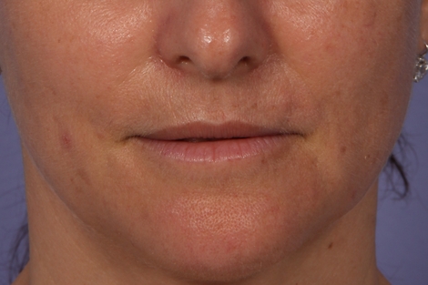 Injectable Fillers before and after photo