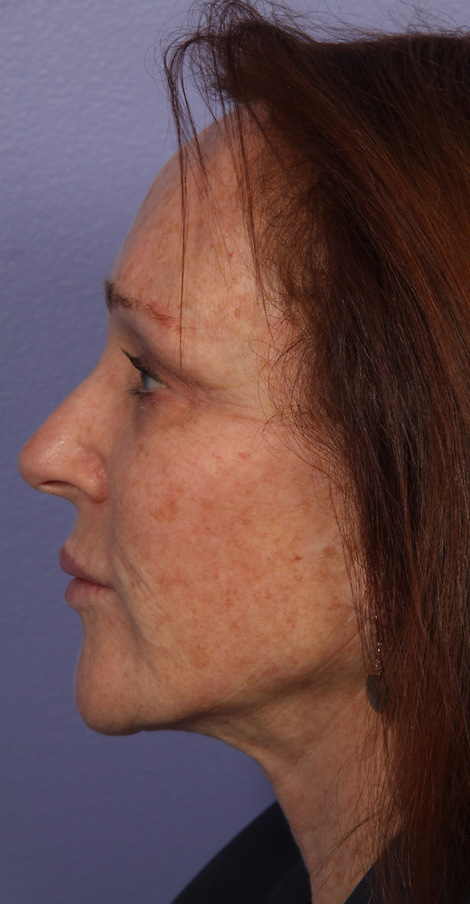 Injectable Fillers before and after photo