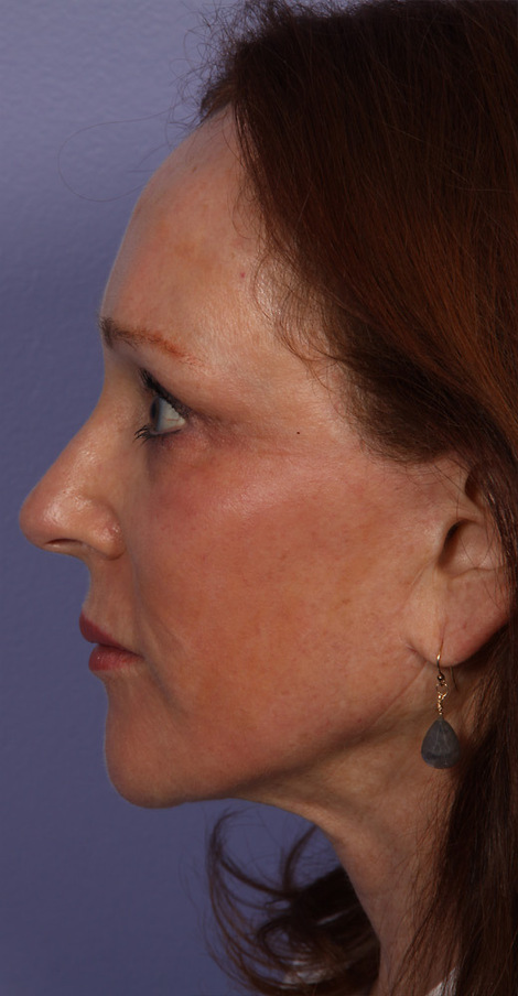 Injectable Fillers before and after photo