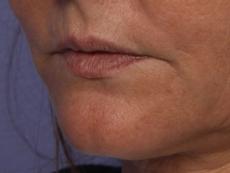 Injectable Fillers before and after photo