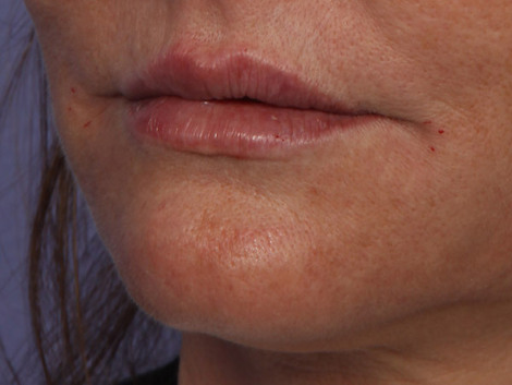 Injectable Fillers before and after photo